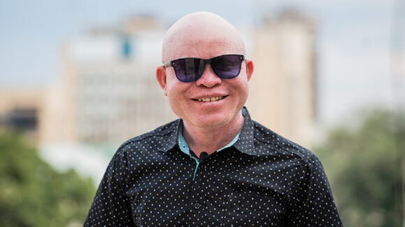 A man who has albinism wearing sunglasses and smiling.